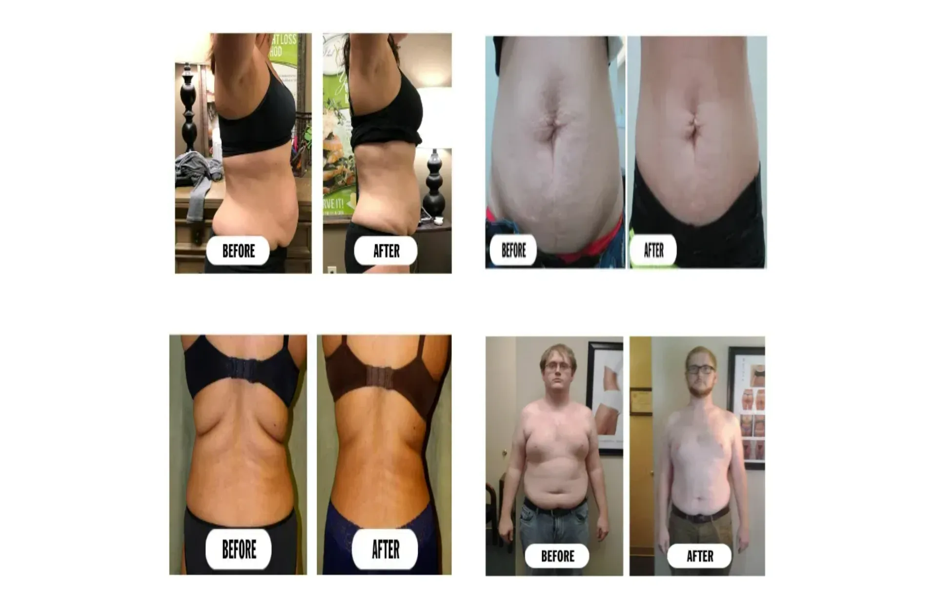 Lipo Laser Weight Loss Funnel screenshot 4
